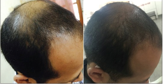 Peak Rejuvenation - PRP Hair Loss