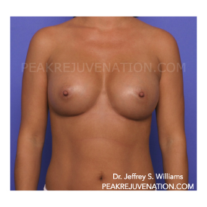 3 month Postop Silicone Breast Augmentation