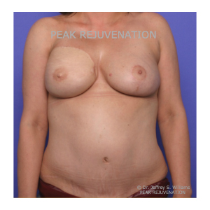 3 Month Postop Breast Reconstruction following Mastectomy for Cancer - DIEP Flap Reconstruction + Nipple Reconstruction for Right Side and Breast Reduction for Left Side