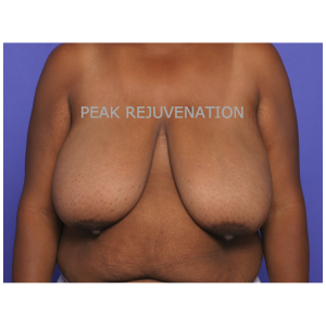 Preop Breast Reduction Mammaplasty for Breast Hypertrophy