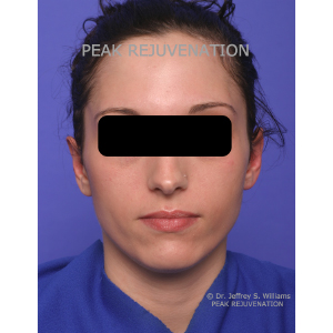 3 month Postop Otoplasty for Prominent Ears