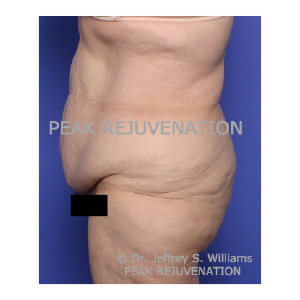 Preop Fleur-de-lis Abdominoplasty (Tummy Tuck) following Massive Weight Loss - Side View