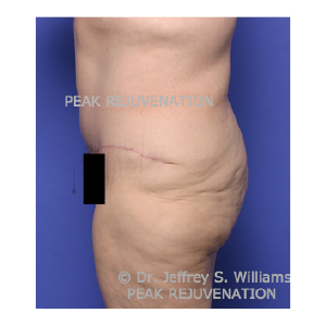 6 weeks Postop Fleur-de-lis Abdominoplasty (Tummy Tuck) following Massive Weight Loss - Side View