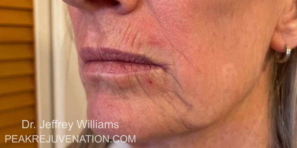 Preop Perioral Dermabrasion