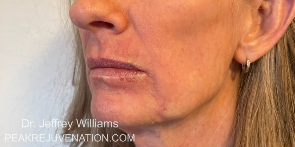 3 months Postop Perioral Dermabrasion